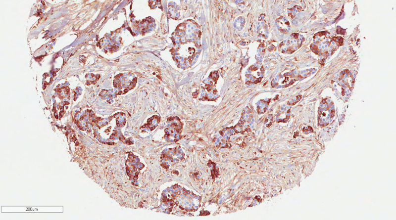 Cartilage protein may contribute to the development of breast cancer