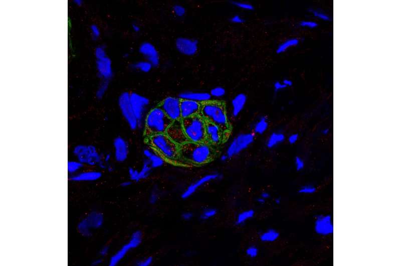 Cell death mechanism may -- paradoxically -- enable aggressive pancreatic cells to live on