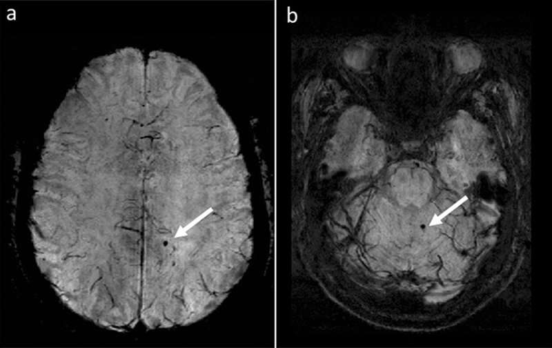 Cerebral microbleeds in MS are associated with increased risk for disability