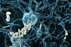 Cerebrovascular disease linked to Alzheimer's