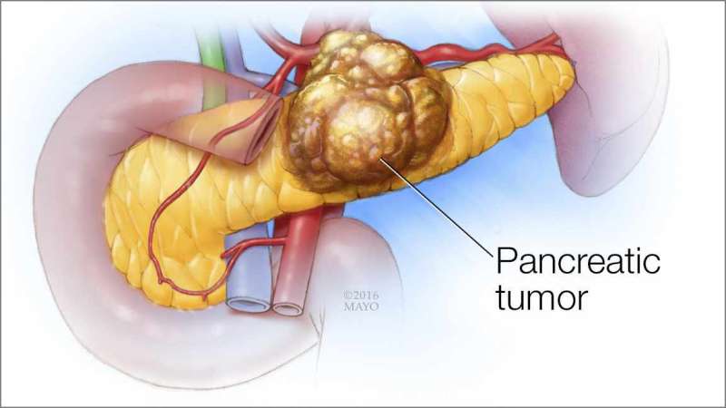 化疗、放疗、手术组合提高胰腺癌患者生存