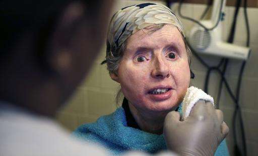 Chimp victim's body rejecting face transplant