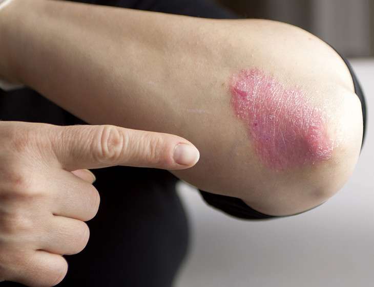 Clearing up common myths about psoriasis
