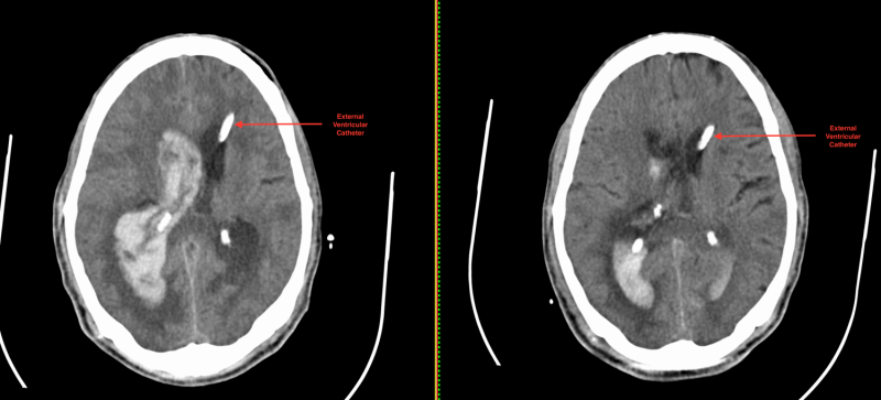 Clot-busting therapy reduces mortality in deadliest form of stroke