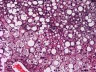 CNIC researchers discover a new target for the treatment of fatty liver disease