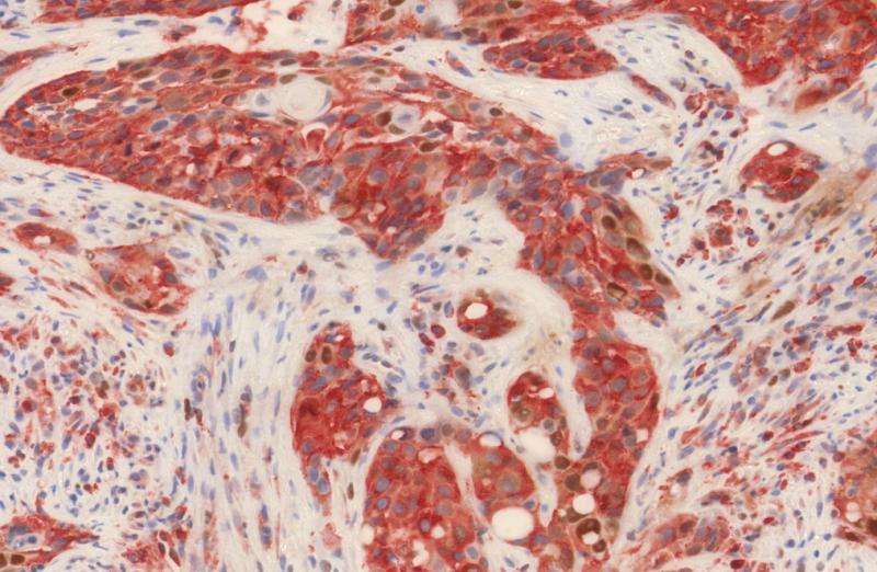 CNIO scientists find new tumor markers for the prognosis of head and neck cancer