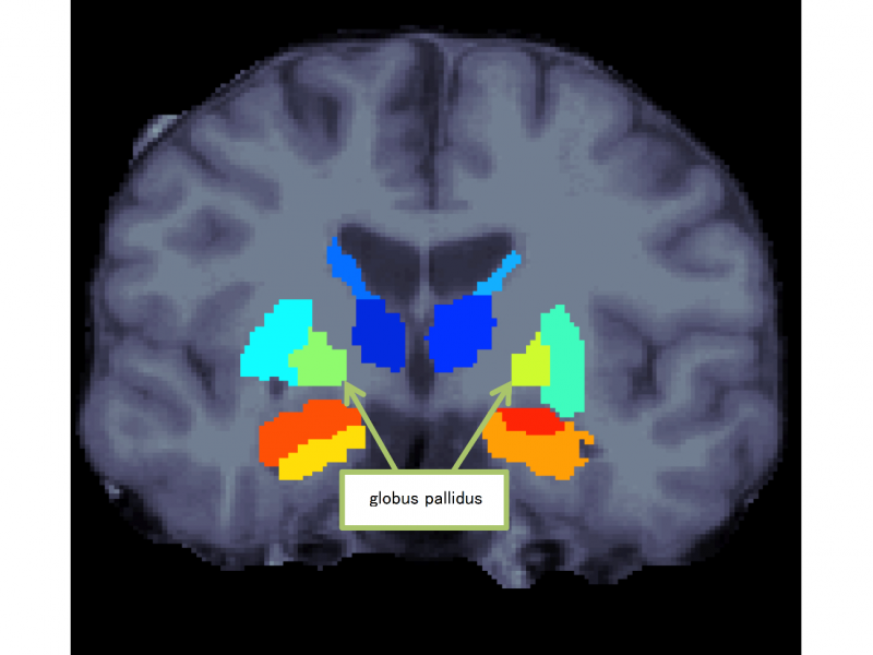 Discovery of the characteristics of subcortical regions in schizophrenia