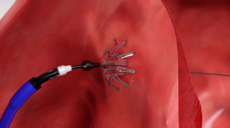 Doctors punch hole in heart wall to help diastolic heart failure
