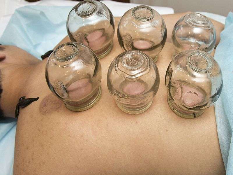 Does 'Cupping' &amp;amp;#61; success for olympic athletes?