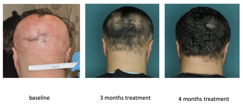 Drug restores hair growth in patients with alopecia areata
