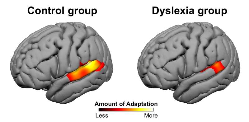 Dyslexics show a difference in sensory processing