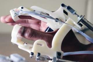 Engineer modifies robotic exoskeleton glove to help cerebral palsy diagnosis in children