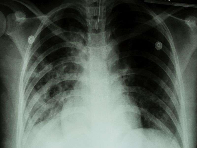 Foreign-born students in U.S. have higher case rate of TB