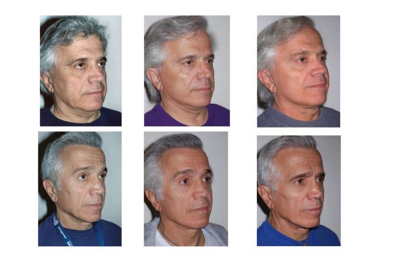 Full-incision facelift superior to short-scar in neck region, study in multiples shows