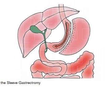 Gastric sleeve may become the new gold standard for morbid obesity
