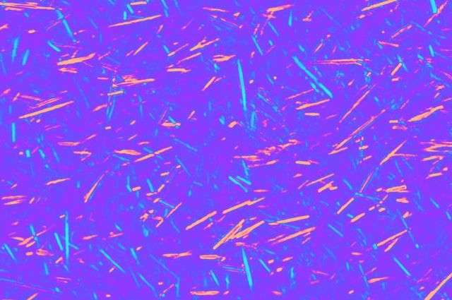 Gout diagnostic platform uses computational microscopy to analyze uric acid crystals