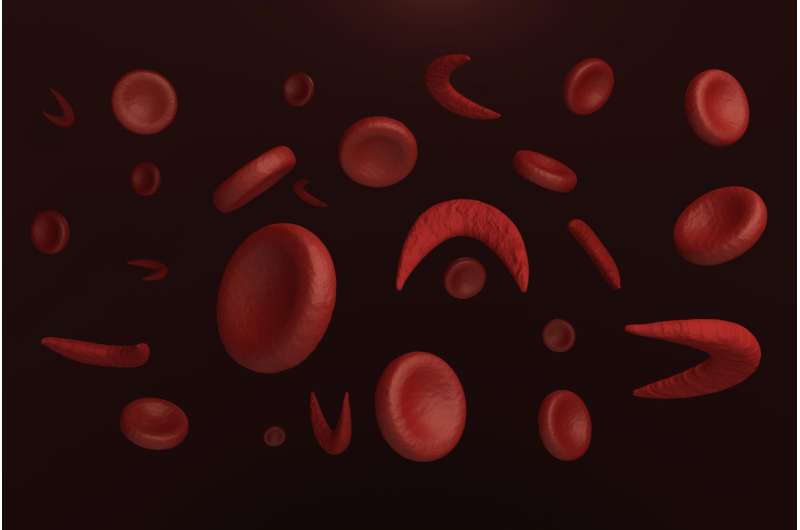 Hydroxyurea improves lung function in children with sickle cell disease