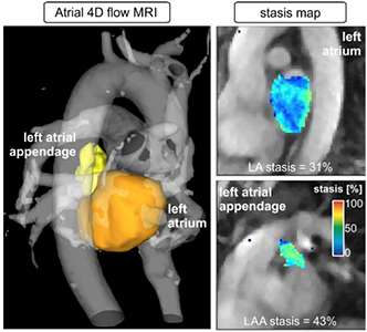 Imaging stroke risk in 4-D: New MRI technique detects blood flow velocity to identify who is most at risk for stroke