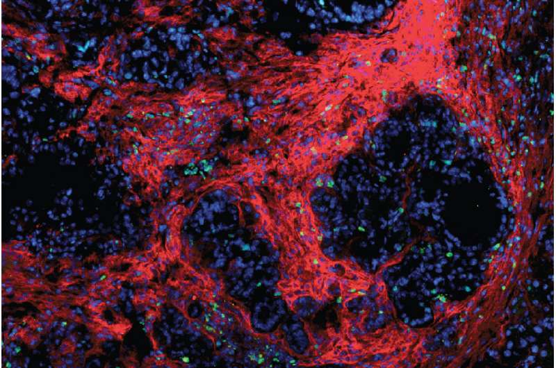 Immune-based therapy in mice shows promise against pancreatic cancer