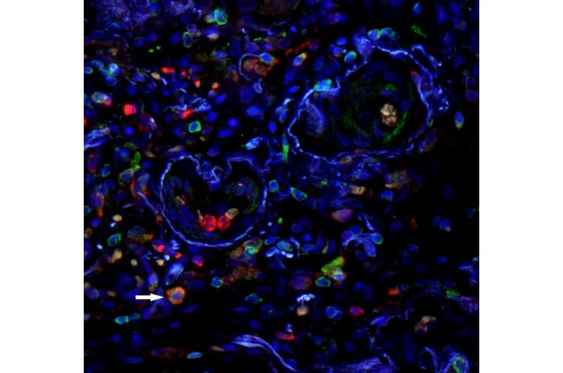 Immune cells as biomarkers for idiopathic pulmonary fibrosis