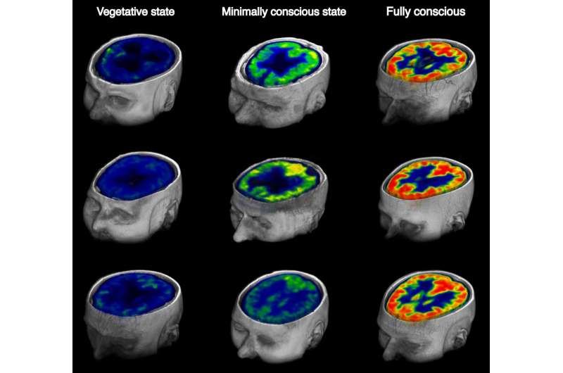 In brain-injured patients, a way to measure awareness or its impending return