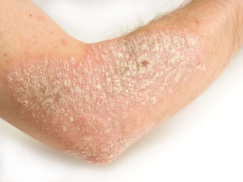 Increased global, subcutaneous inflammation in psoriasis