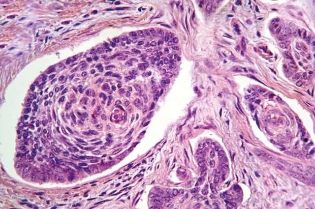 Insight into a rare genetic syndrome could lead to treatments for basal cell carcinoma