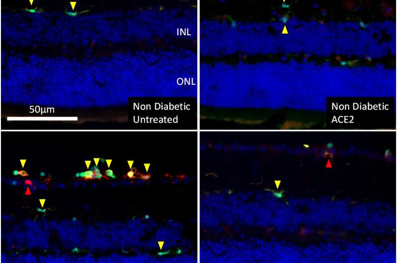 Intraocular therapy prevents or reverses diabetic retinopathy in mice