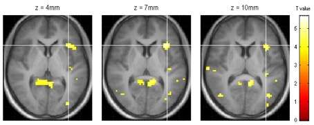 Just add water? New MRI technique shows what drinking water does to your appetite, stomach and brain