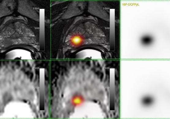 London researchers first in Canada to use improved prostate cancer imaging