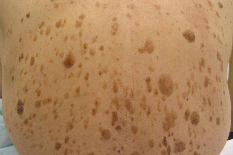 Mass. General study points to the first topical treatment for common benign skin lesions