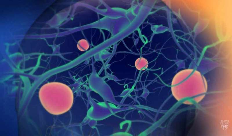 Mayo Clinic study shows increase in Parkinson's disease over 30 years