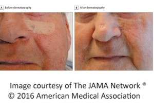 Medical tattooing improves perception of scar/graft appearance, quality of life