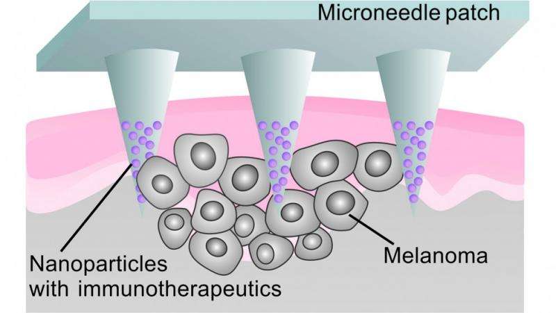 Microneedle patch delivers localized cancer immunotherapy to melanoma
