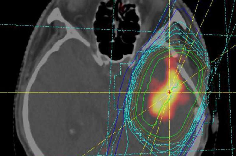 microRNAs help to predict disease progression in brain tumors
