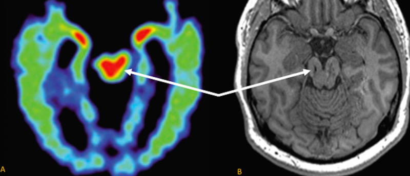 MRI scans may be useful in diagnosing chronic traumatic encephalopathy, UCLA study shows