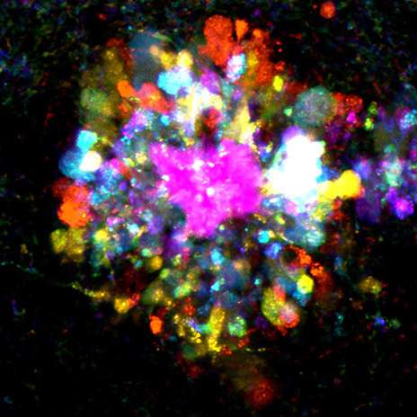 神经科医生创建了阿尔茨海默氏菌在神经元中的图像