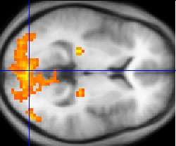 Neuromotor problems at the core of autism, study says