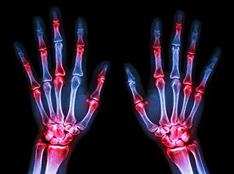 New drug for the treatment of rheumatoid arthritis shows promising success