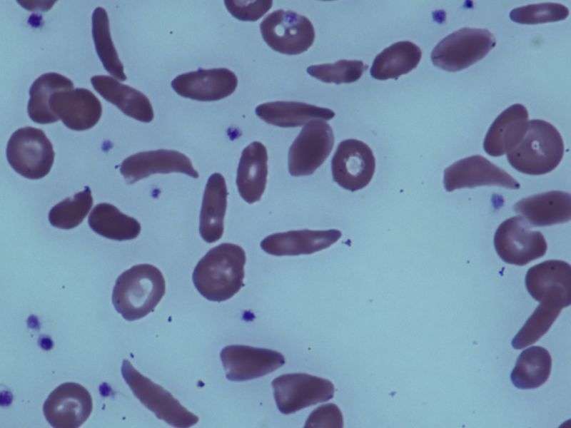New drug might reduce sickle cell pain crises