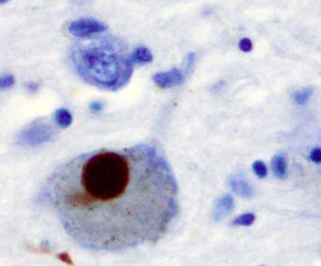 New study surveys genetic changes linked with Parkinson's disease