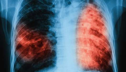 New trials offer hope for TB treatment