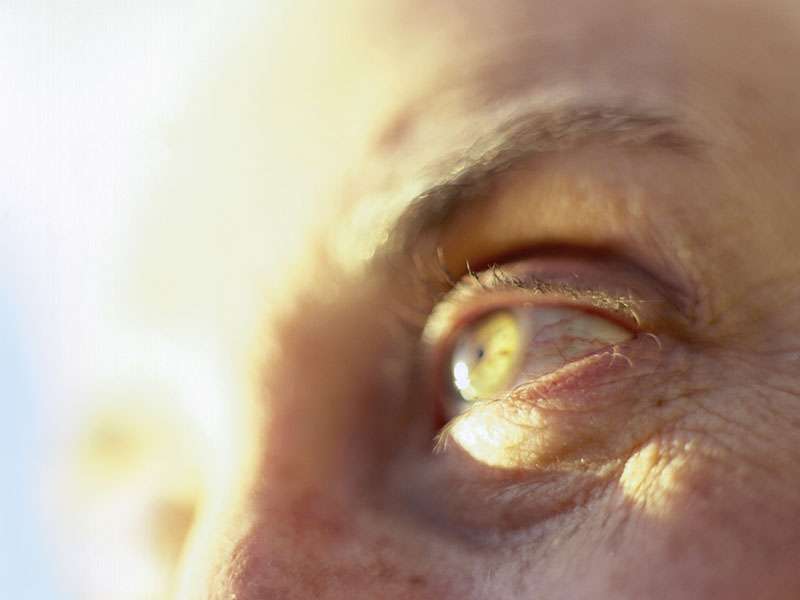 Nonablative radiofrequency tx ups skin elasticity around eyes