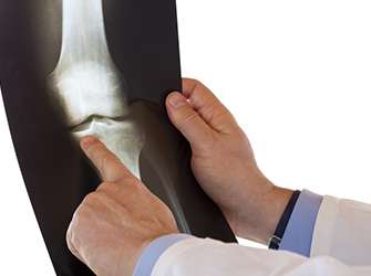Osteoarthritis: carbohydrate-binding protein promotes inflammation