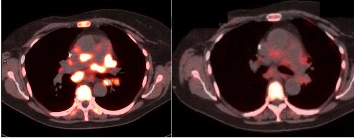 Penn experts call for expansion of molecular imaging in precision cancer care