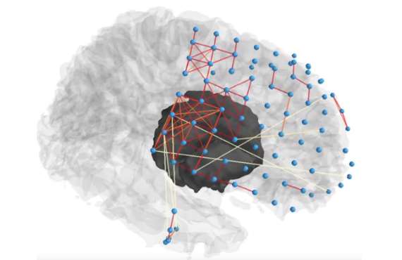 Penn researchers use network science to help pinpoint source of seizures