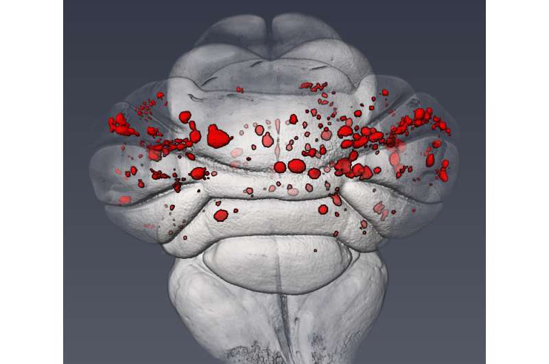 Penn study describes the molecular cause of common cerebrovascular disease