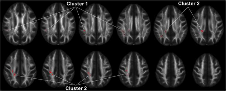 People with anger disorder have decreased connectivity between regions of the brain