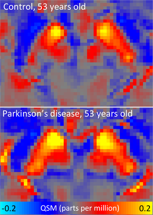 People with Parkinson's show altered iron levels in their brains