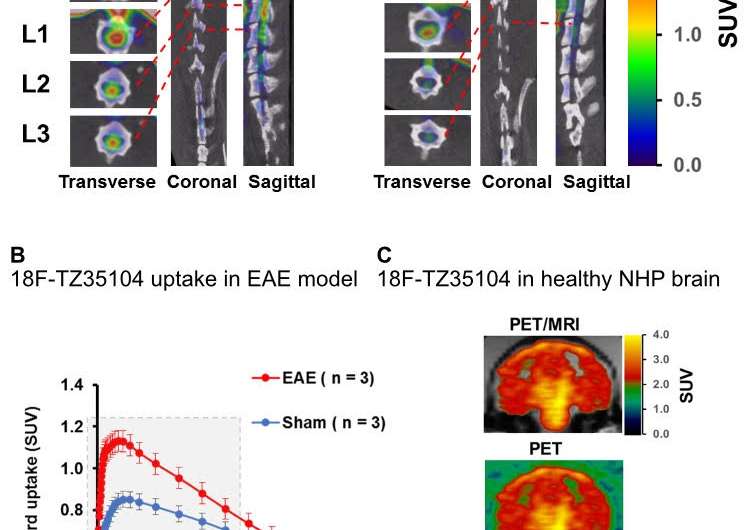 PET detects neuroinflammation in multiple sclerosis